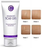 Fast Results CSCS Advance Scar Remover Cream with 
